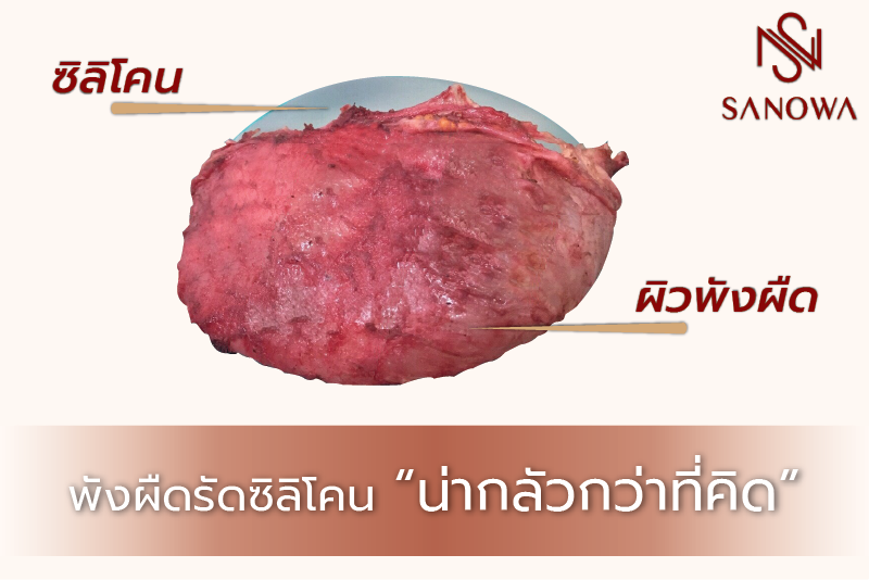 อันดับแรกมาทำความรู้จัก พังผืด กันก่อน